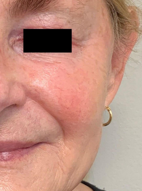Cartessa Prisma 3D Skin Rejuvenation
