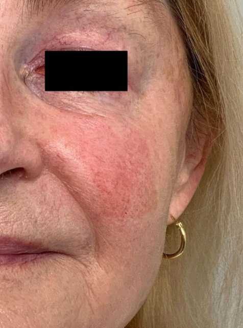 Cartessa Prisma 3D Skin Rejuvenation