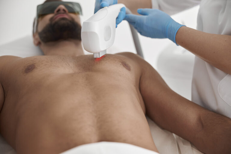 Laser Hair Removal