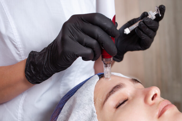 Microneedling with PRP