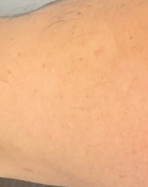 Cartessa Prisma 3D Skin Rejuvenation