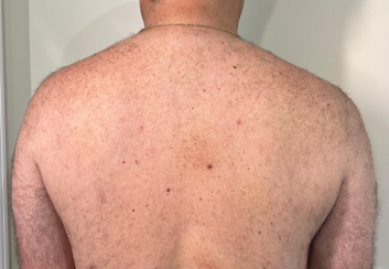 Laser Hair Removal with Candela
