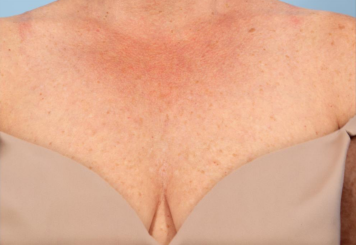 Laser Hair Removal with Candela