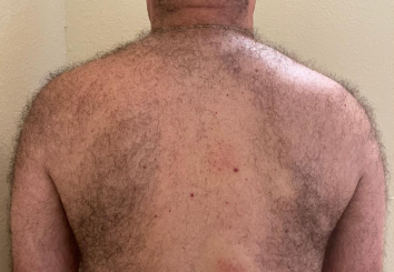 Laser Hair Removal with Candela