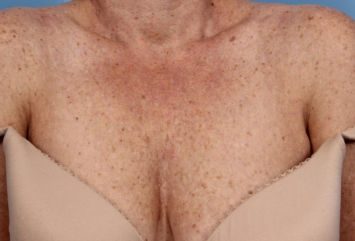 Laser Hair Removal with Candela