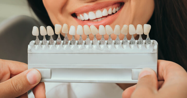 Teeth Whitening